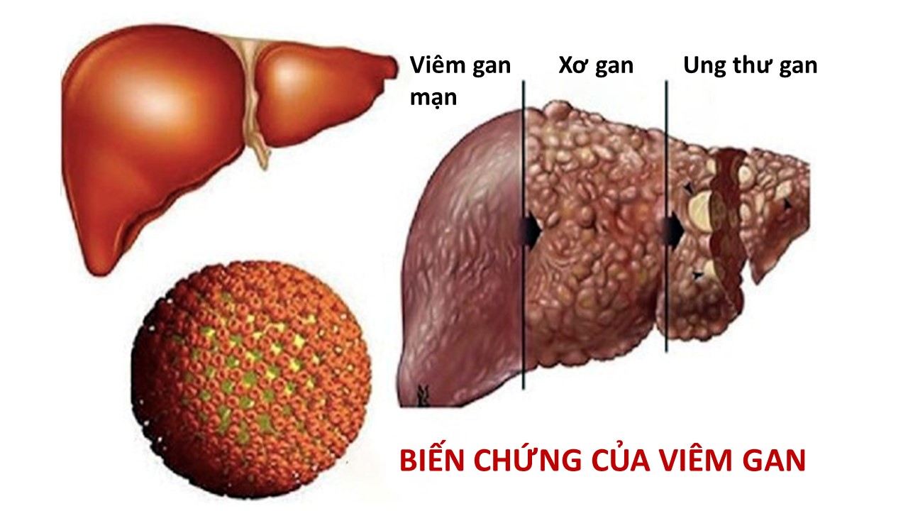 viêm gan B và xơ gan - Image 2