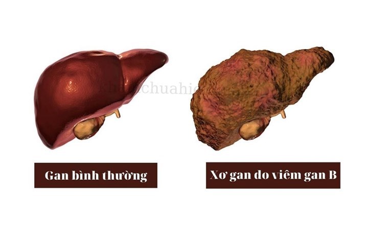 viêm gan B và xơ gan - Image 3