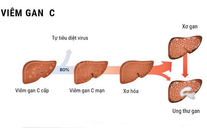 viêm gan C mạn tính - Image 2