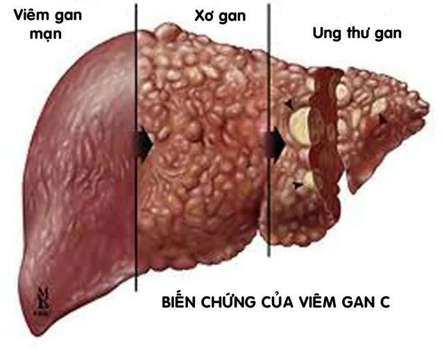 viêm gan C ở người lớn - Image 2