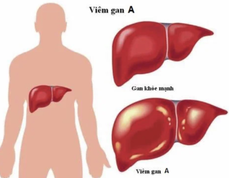 viêm gan là gì - Image 4