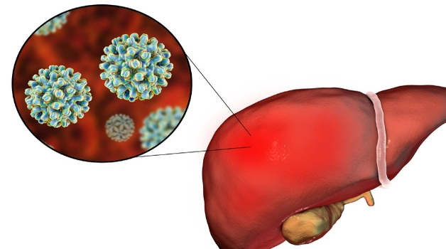 viêm gan virus - Image 5