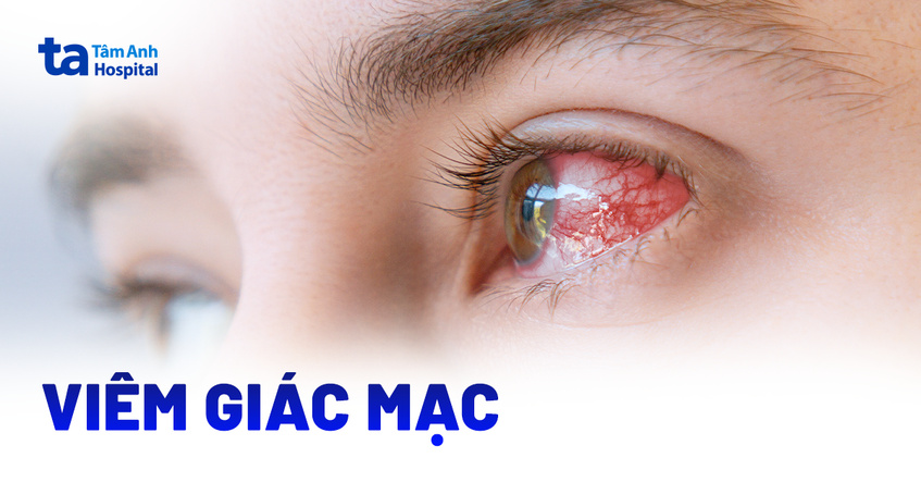viêm giác mạc có phải mổ không - Image 2