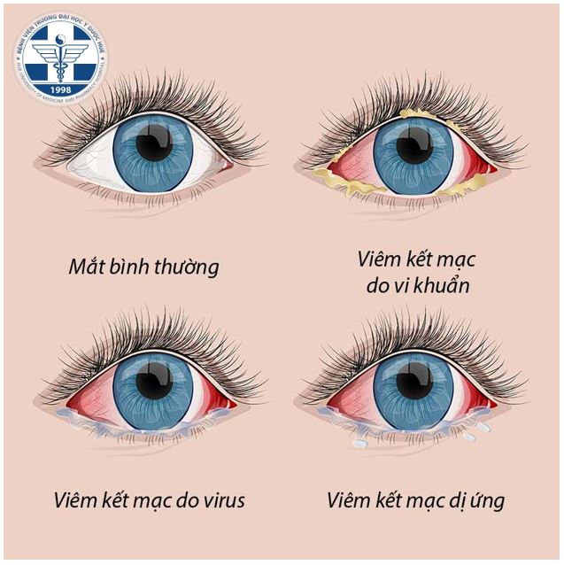 viêm kết mạc mi mắt - Image 2