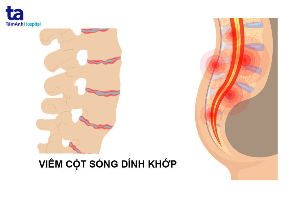 viêm khớp cột sống