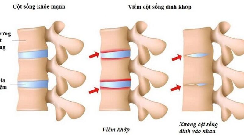 viêm khớp cột sống - Image 3