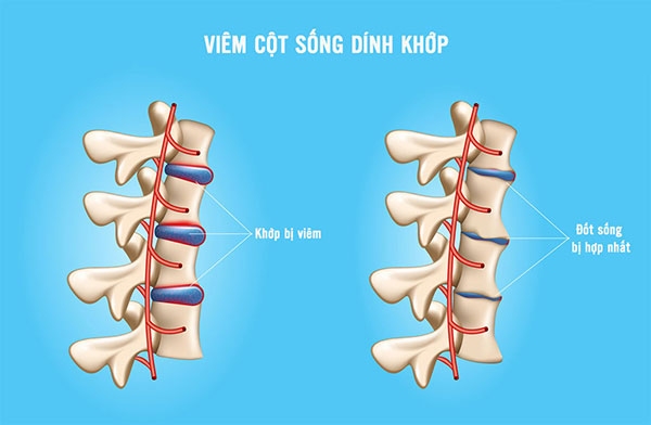 viêm khớp cột sống - Image 5