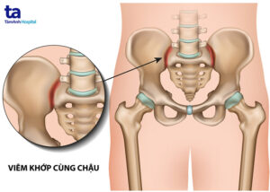 viêm khớp cùng chậu