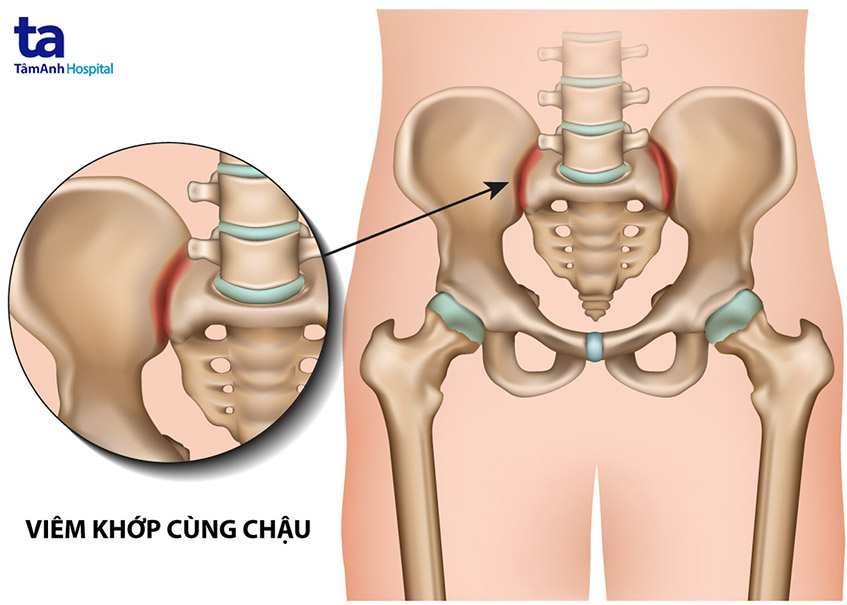 viêm khớp cùng chậu bệnh học