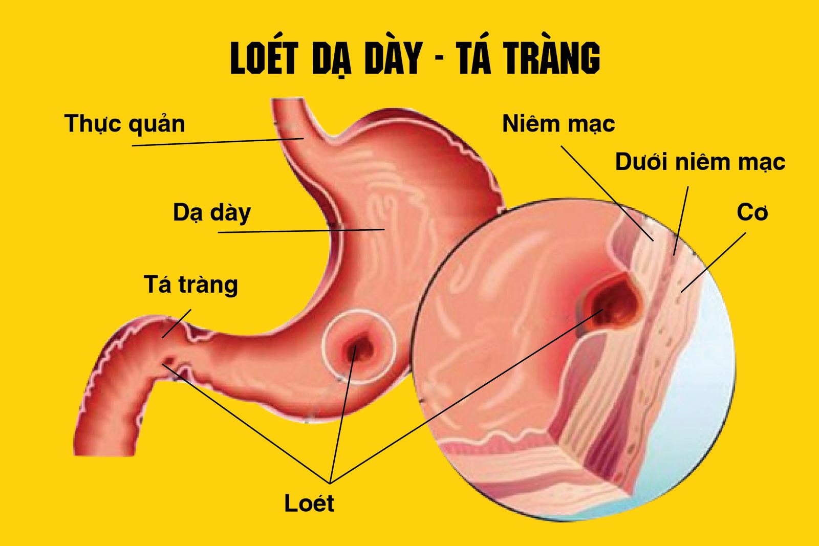 viêm loét dạ dày - Image 3