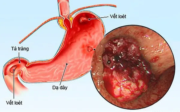 viêm loét dạ dày - Image 4