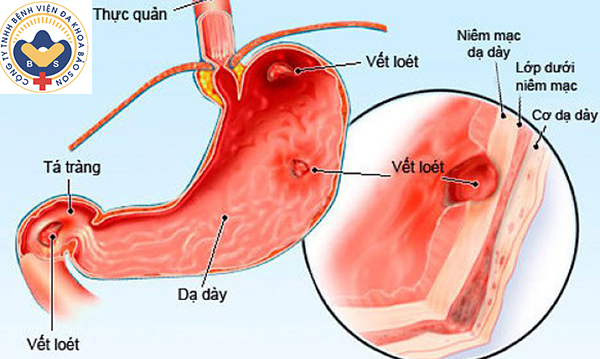 viêm loét dạ dày là gì - Image 3