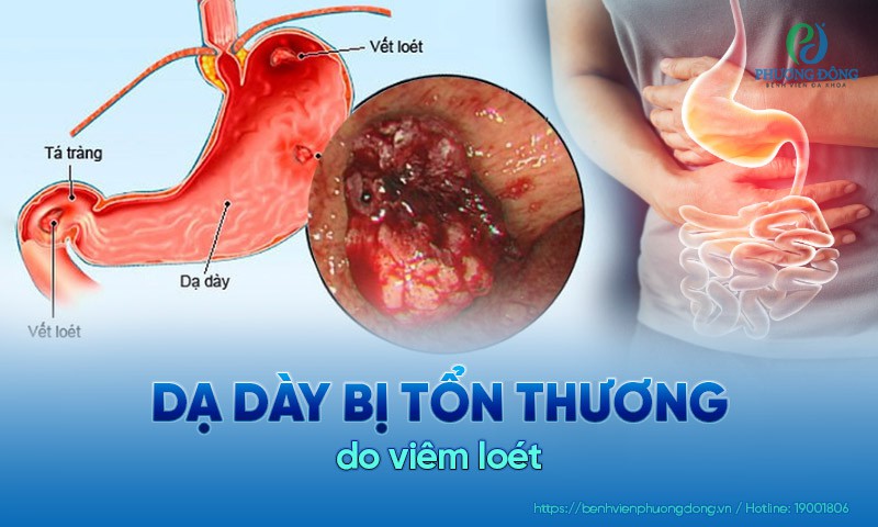 viêm loét dạ dày ở người cao tuổi - Image 4