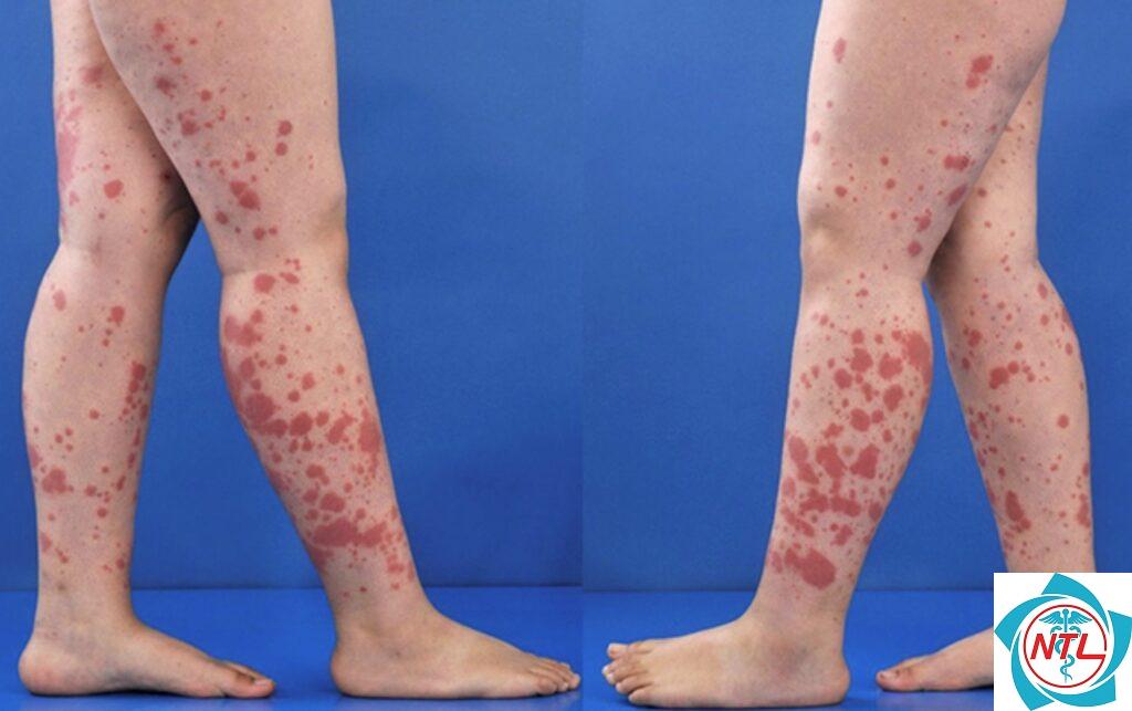viêm mạch dị ứng ở da