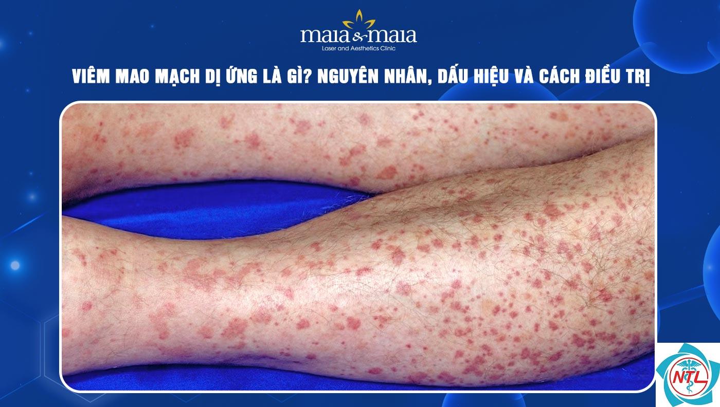 viêm mạch dị ứng ở da - Image 3