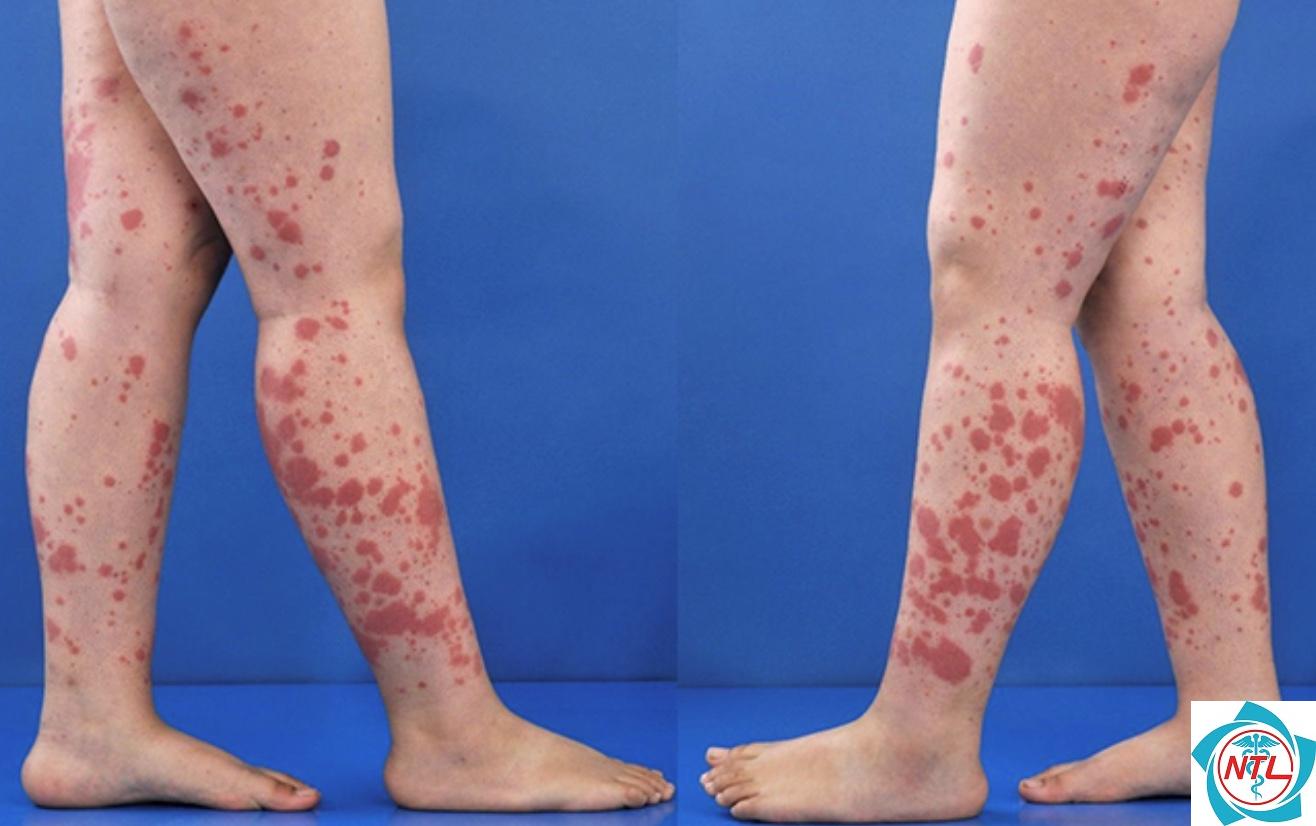 viêm mạch dị ứng ở da - Image 1