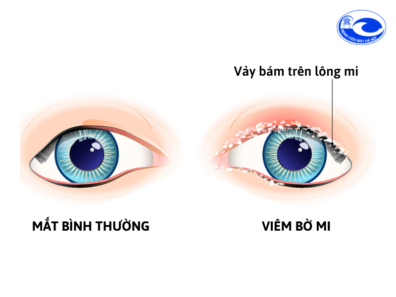 viêm mí mắt - Image 4