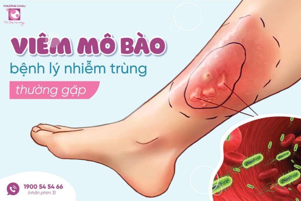 viêm mô tế bào