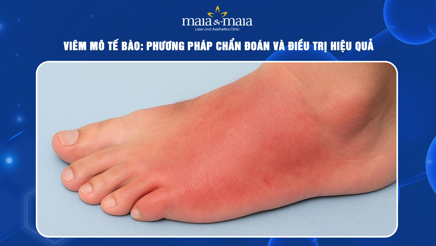 viêm mô tế bào - Image 4