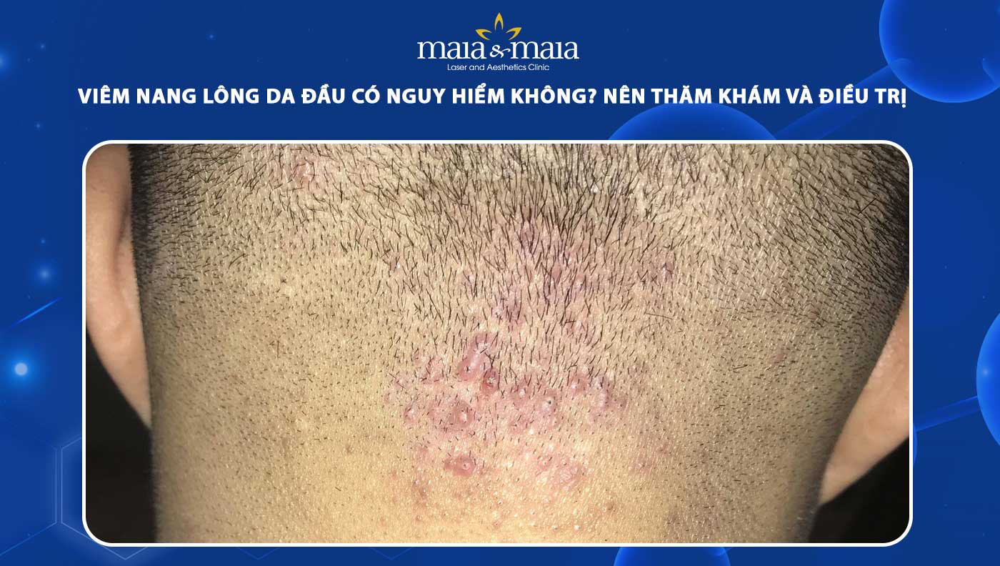 viêm nang lông da đầu - Image 2