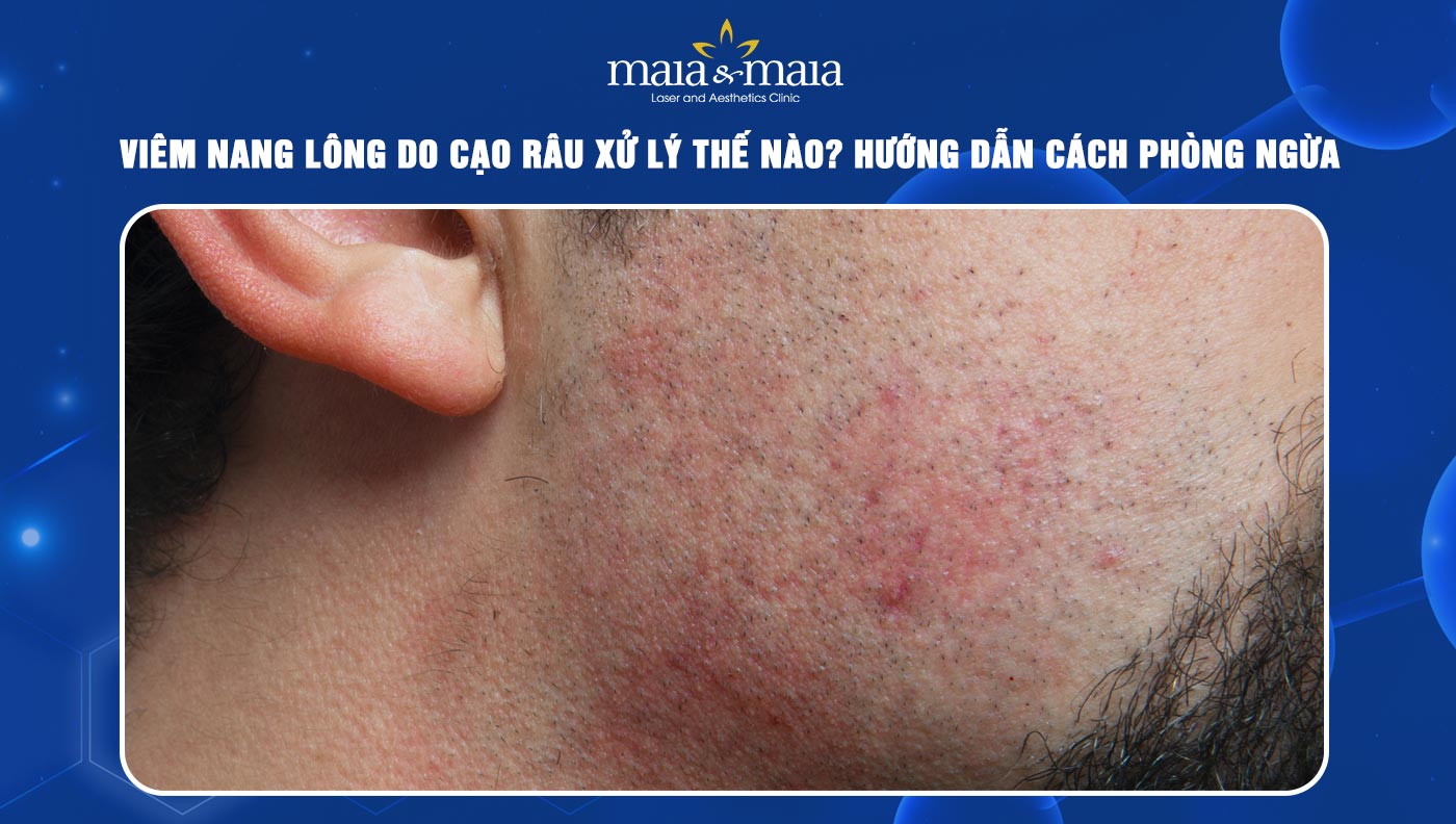 viêm nang lông do cạo lông - Image 2