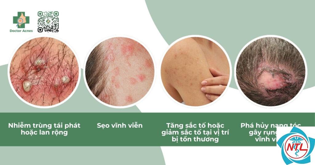 viêm nang lông do nấm