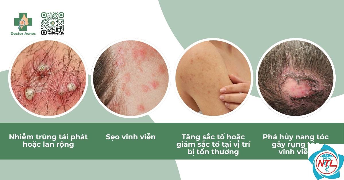 viêm nang lông do nấm - Image 1