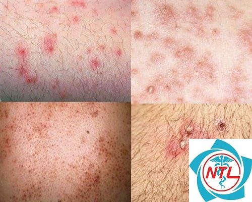 viêm nang lông do vi khuẩn