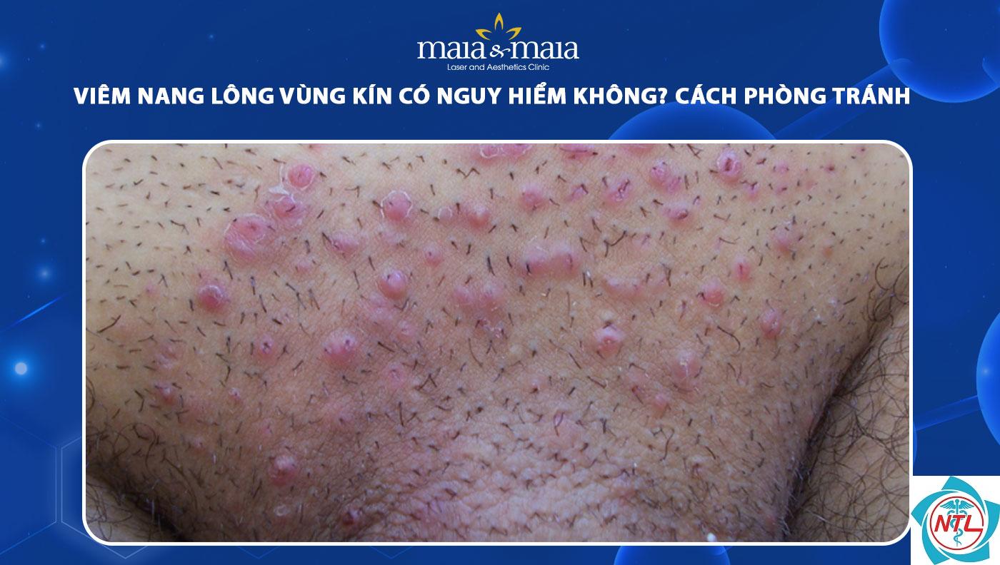 viêm nang lông mủ - Image 3