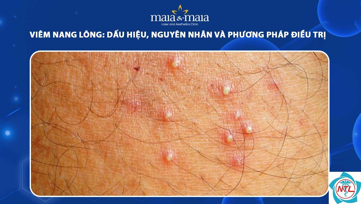 viêm nang lông nông - Image 4