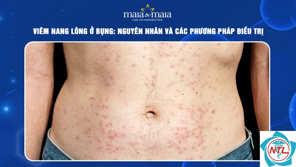 viêm nang lông ở bụng