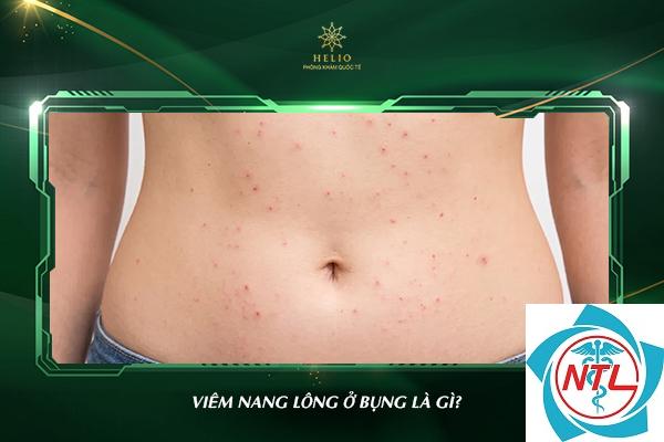 viêm nang lông ở bụng - Image 5
