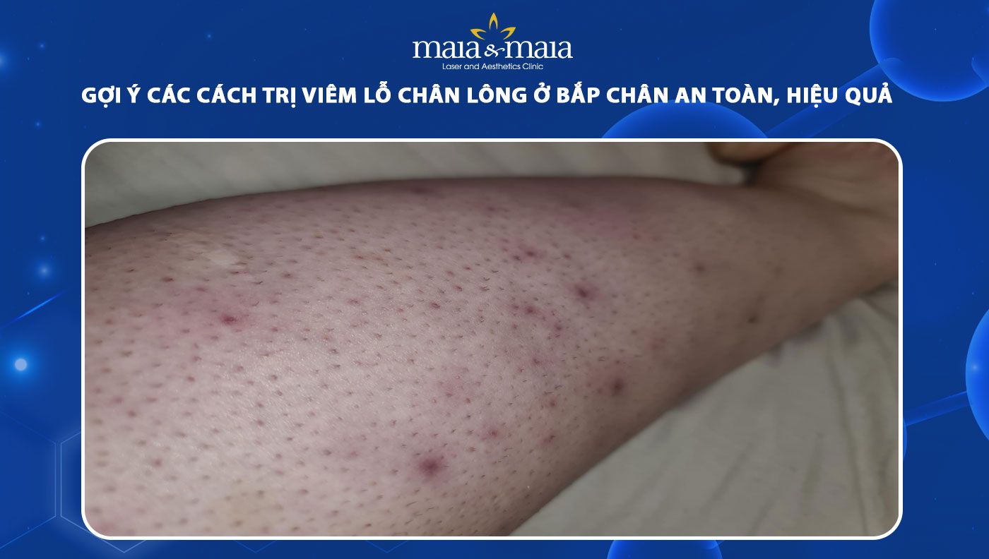 viêm nang lông ở chân - Image 2