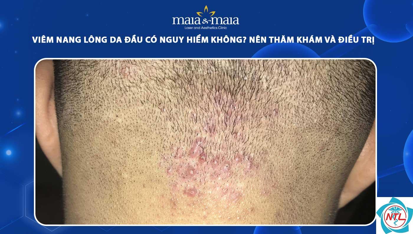 viêm nang lông ở da đầu - Image 3