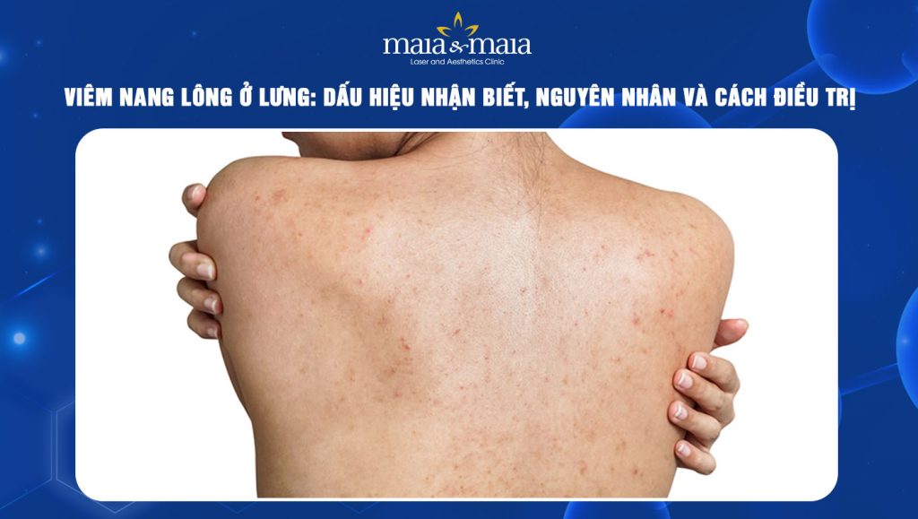 viêm nang lông ở lưng - Image 3