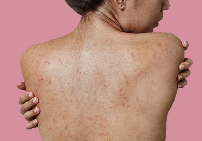 viêm nang lông ở lưng