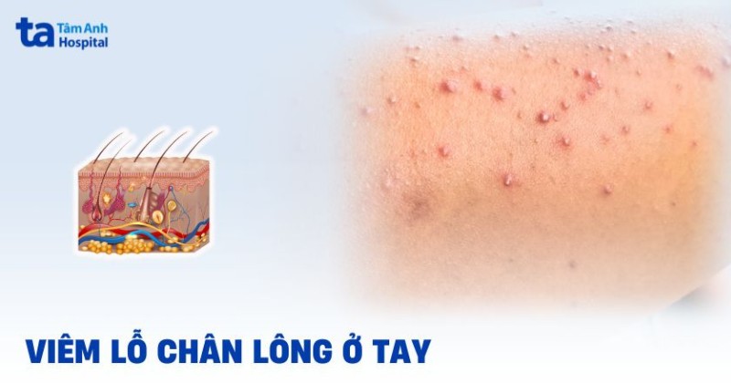 viêm nang lông ở tay - Image 4