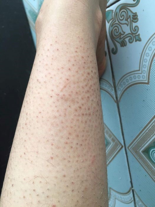 viêm nang lông ở tay