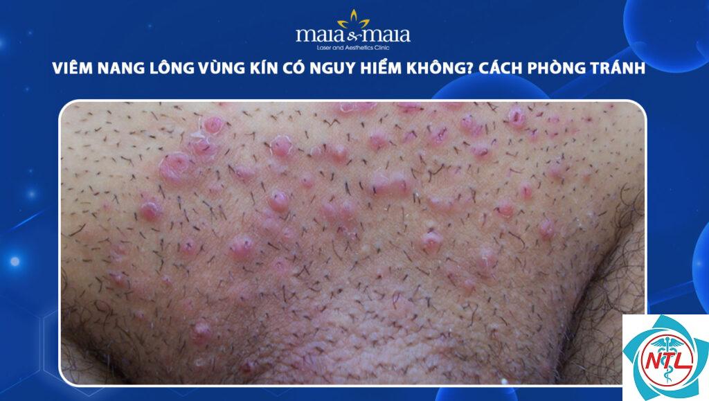 viêm nang lông ở vùng kín