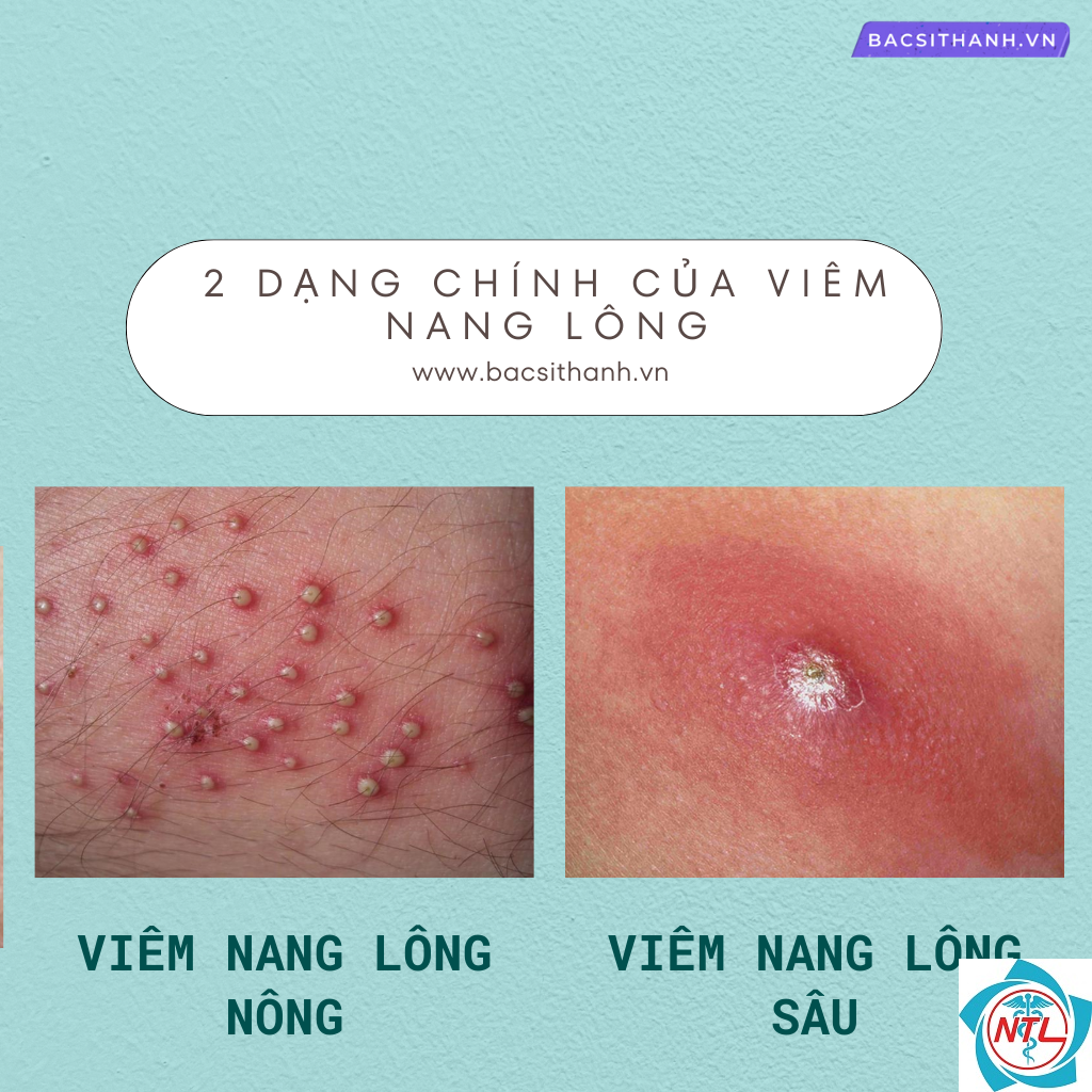 viêm nang lông sâu - Image 5