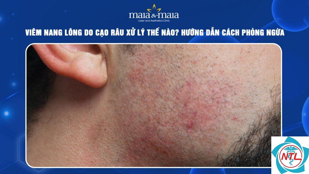 viêm nang lông sau cạo râu - Image 2