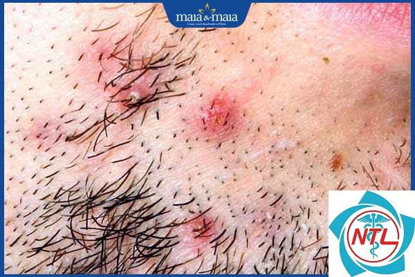 viêm nang lông sau cạo râu