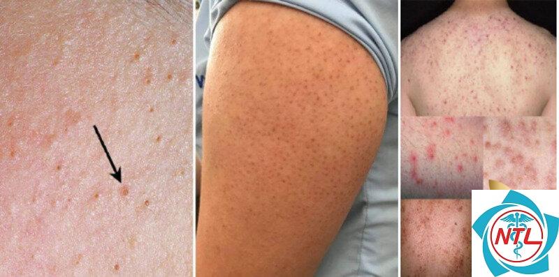 viêm nang lông sau tẩy lông