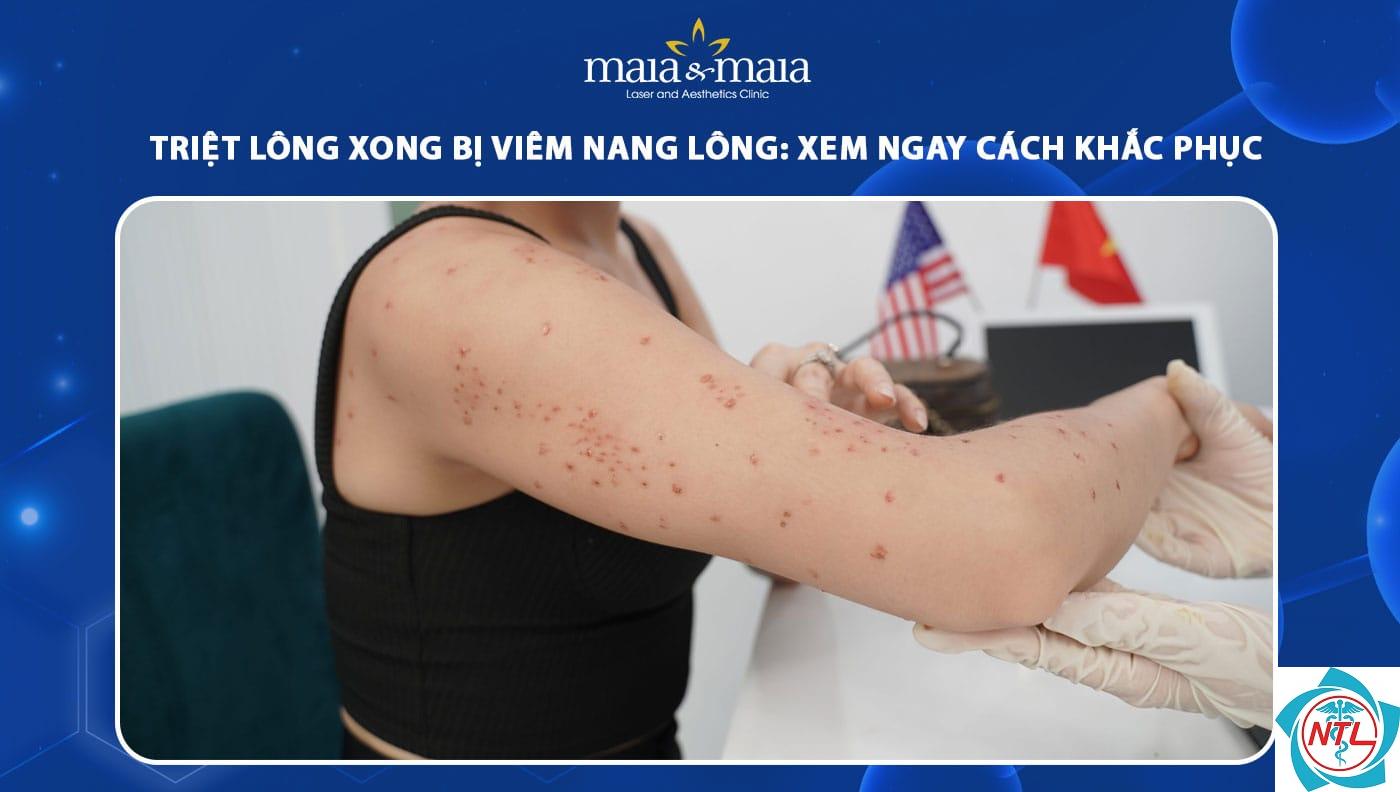 viêm nang lông sau triệt lông - Image 3