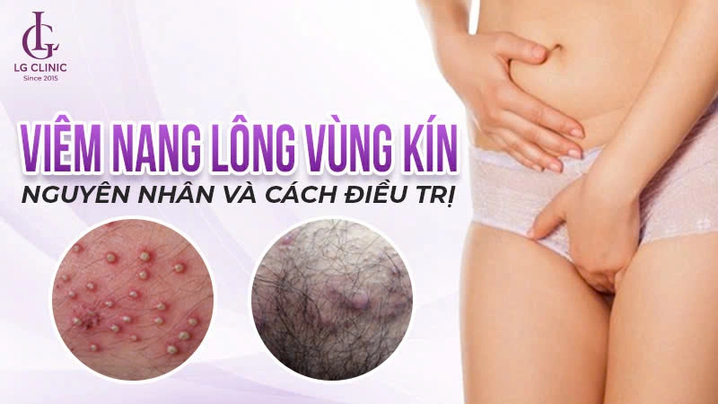 viêm nang lông vùng kín - Image 3