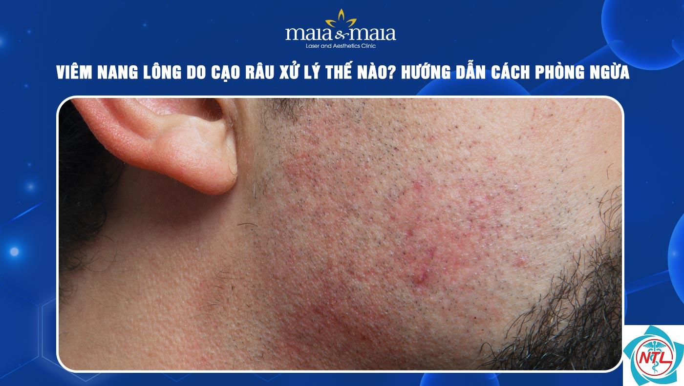 viêm nang lông vùng râu - Image 2