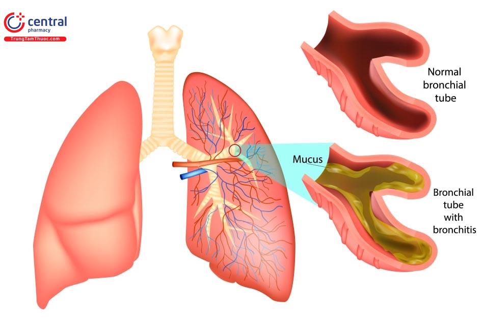 viêm phế quản - Image 4