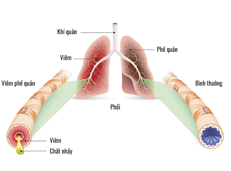 viêm phế quản cấp - Image 2