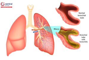 viêm phế quản cấp