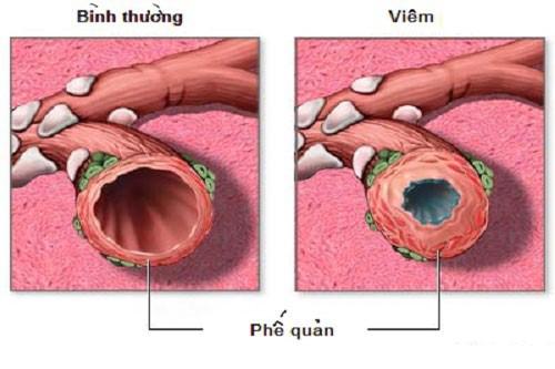 viêm phế quản cấp - Image 4